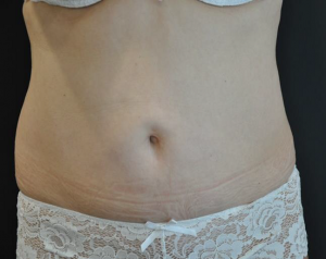 abdomen après cryolipolyse