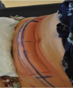 coolsculpting Cryolipolyse nantes