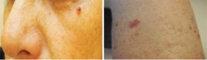 Chirurgie dermatologique Nantes