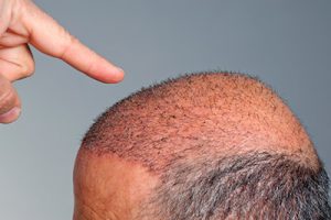 contrer la perte de cheveux